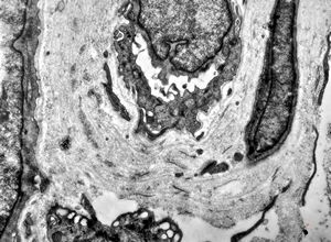 F,48y. | reduplication of endothelial basement membranes - skin - susp. lupus erythematodes F,48y. | reduplication of endothelial basement membranes - skin - susp. lupus erythematodes